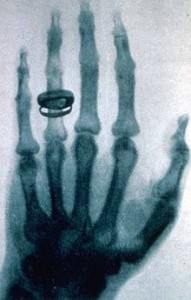 Radiografia della mano della moglie di Albert von Kölliker eseguita da Röntgen.